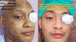 Kisah Tragis Seorang Pria di Medan yang Kehilangan Bola Mata Akibat Kanker: Gejala yang Perlu Diketahui