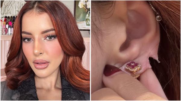 Kondisi Mengkhawatirkan! Daun Telinga Tasya Farasya Terbelah