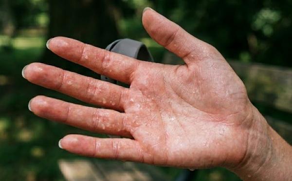 Keringat Berlebih di Telapak Tangan: Tanda Hiperhidrosis yang Perlu Diketahui