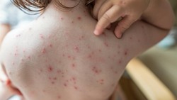 Panduan Kemenkes untuk Mencegah Campak pada Anak Melampaui Imunisasi