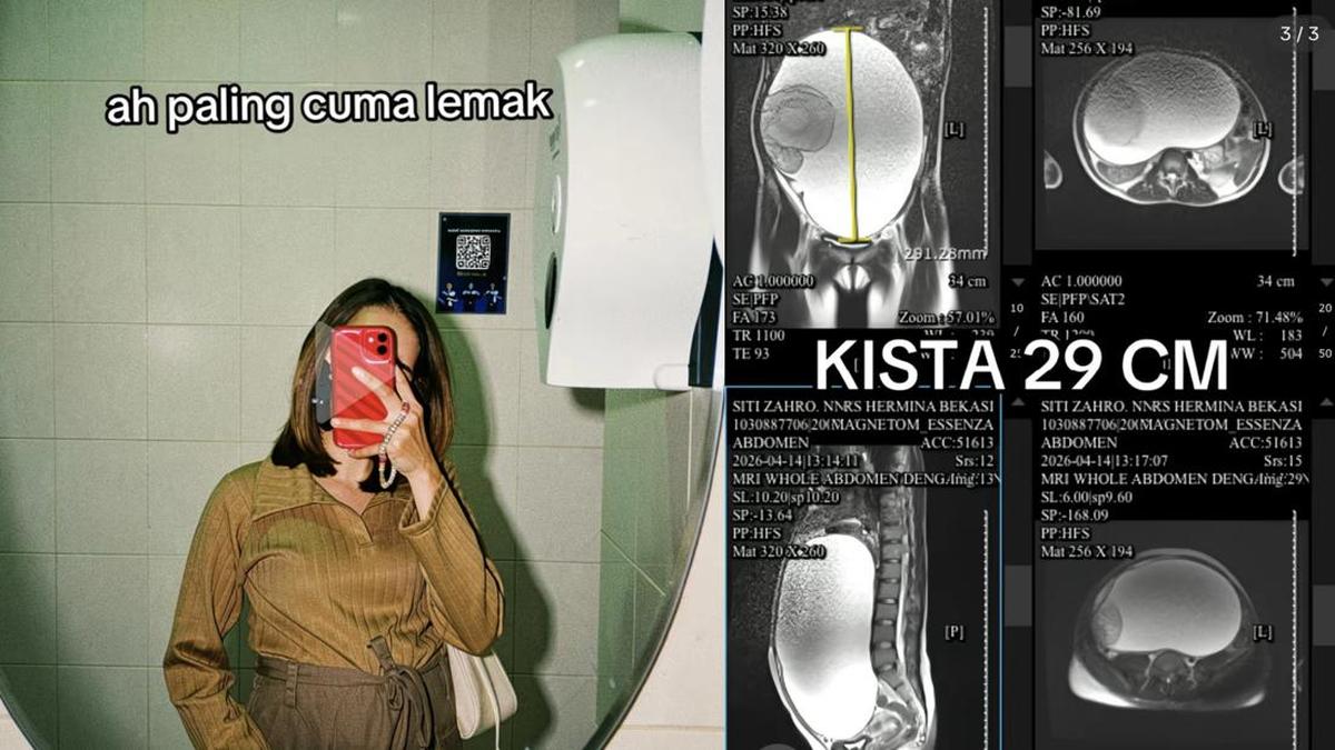 Kisah Siti Zahro: Wanita Bekasi Berjuang Melawan Kista Ovarium Seukuran 29 Cm